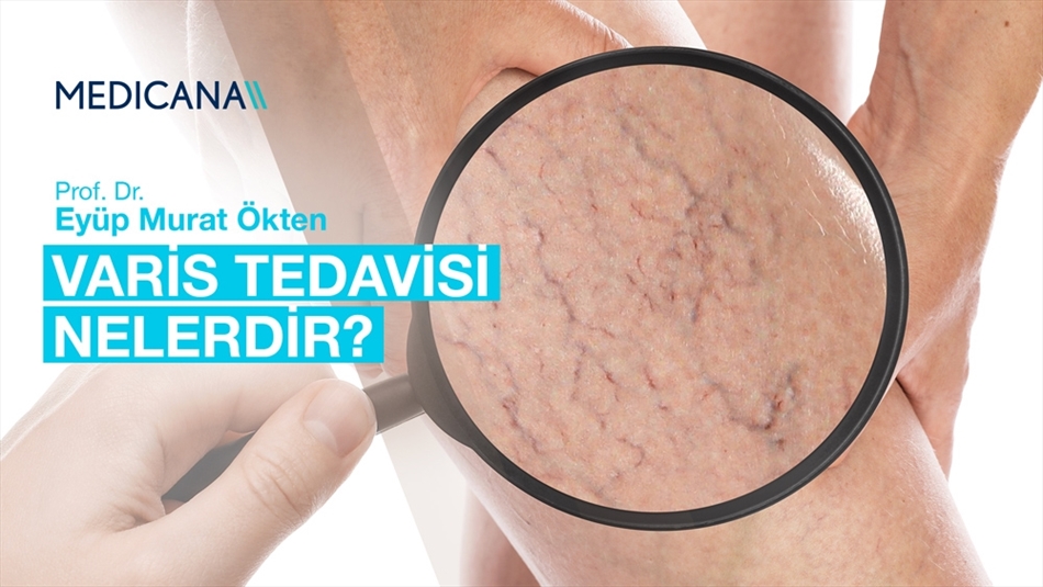 Varis Tedavisi Nelerdir?