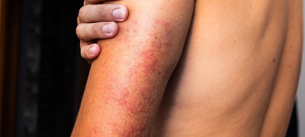 Vaskülit nedir? Vaskülitin (damar iltihabı) belirtileri nelerdir?