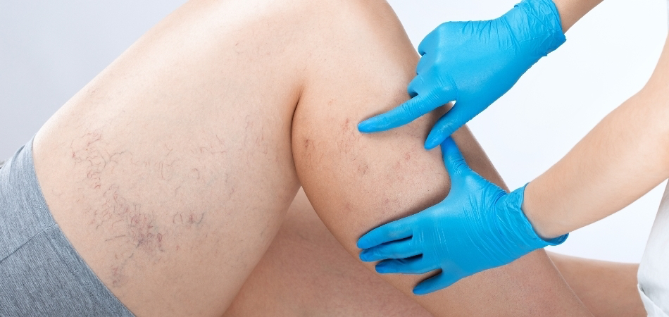 Venöz yetmezliği nedir? Venöz yetmezliği belirtileri nelerdir?