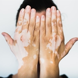 Vitiligo