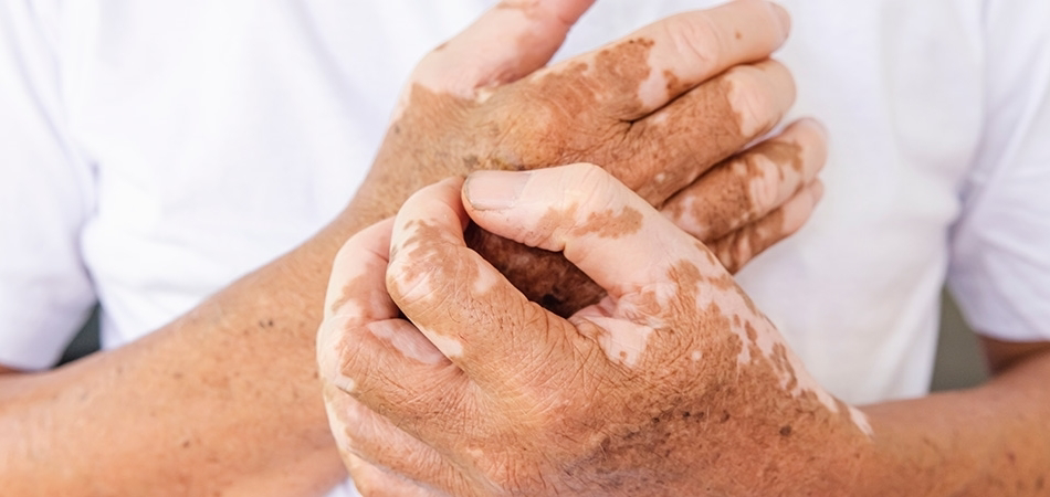 Vitiligo nedir? Vitiligo belirtileri, nedenleri ve tedavi seçenekleri