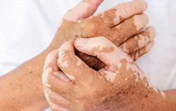 Vitiligo nedir? Vitiligo belirtileri, nedenleri ve tedavi seçenekleri