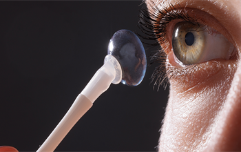 Miyopi nedir? Miyopi belirtileri nelerdir ve nasıl tedavi edilir?