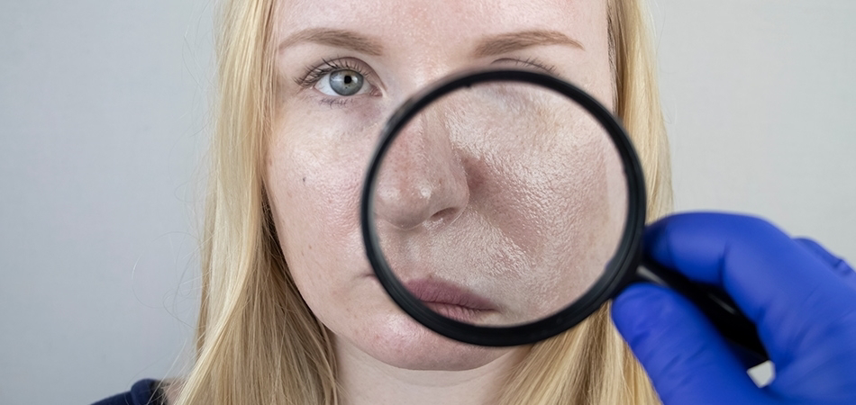 Yağlı cilt tipine sahip olanlar ne yapmalı? Yağlı ciltler için evde uygulanabilecek maskeler...