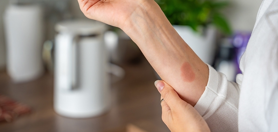 Yanığa ne iyi gelir? Yanık nasıl geçer?