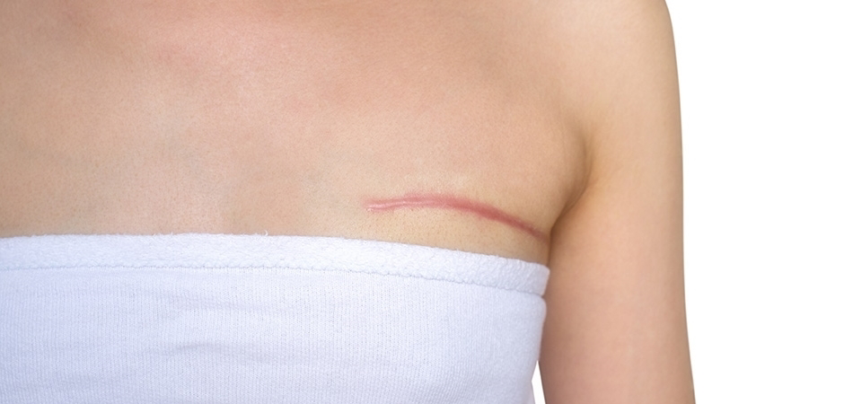 Yara izi nasıl yok edilir? Yara izi ne zaman geçer?