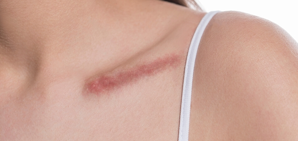 Yara izi neden kaybolmaz?