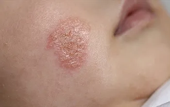 Yenidoğan bebeklerde mantar neden olur? Pişik ve mantar nasıl ayırt edilir?