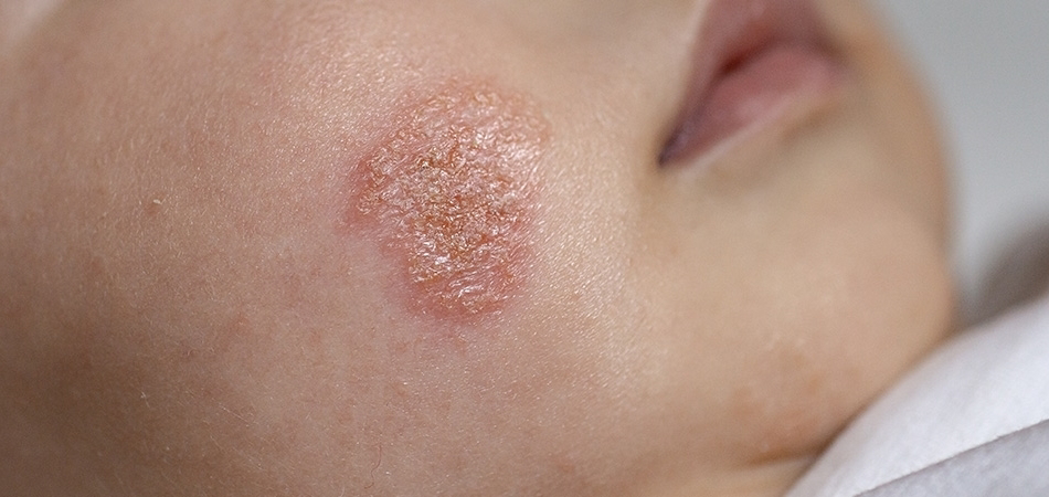 Yenidoğan bebeklerde mantar neden olur? Pişik ve mantar nasıl ayırt edilir?