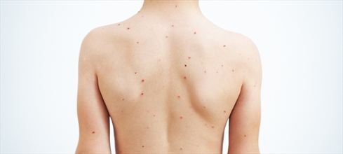 Suçiçeği belirtileri nelerdir? Suçiçeği hastalığı kaç gün sürer?