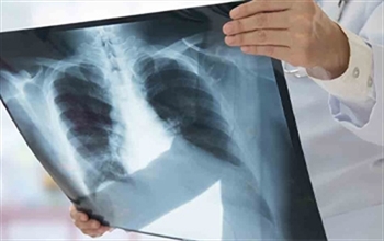 Her yıl 1 milyon 300 bin çocuk kaybediliyor: Zatürre nedir?