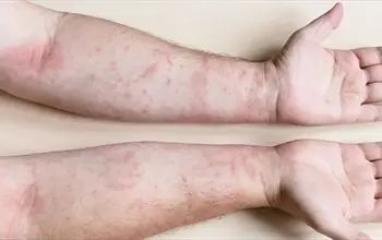 Zona nedir, neden olur? Zona nasıl geçer?